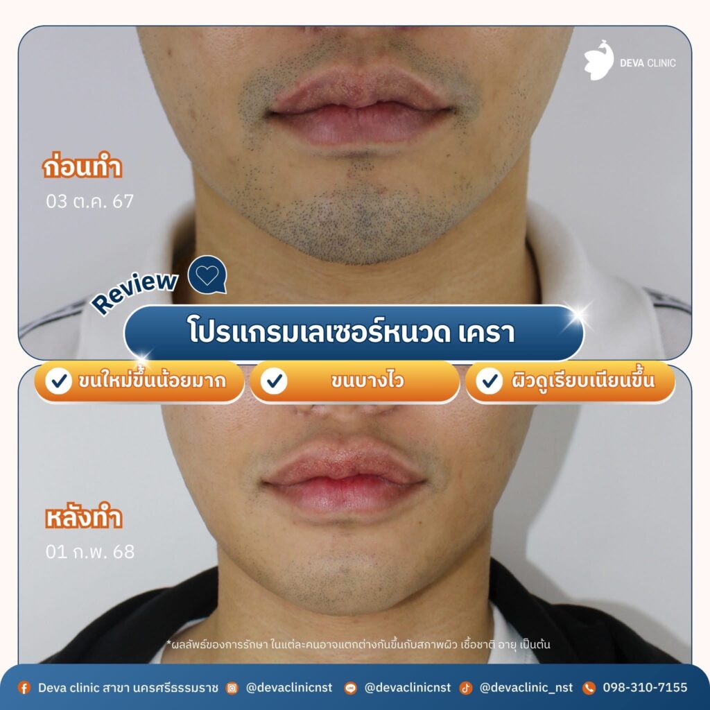 Service-YAG lp หนวด เครา 1