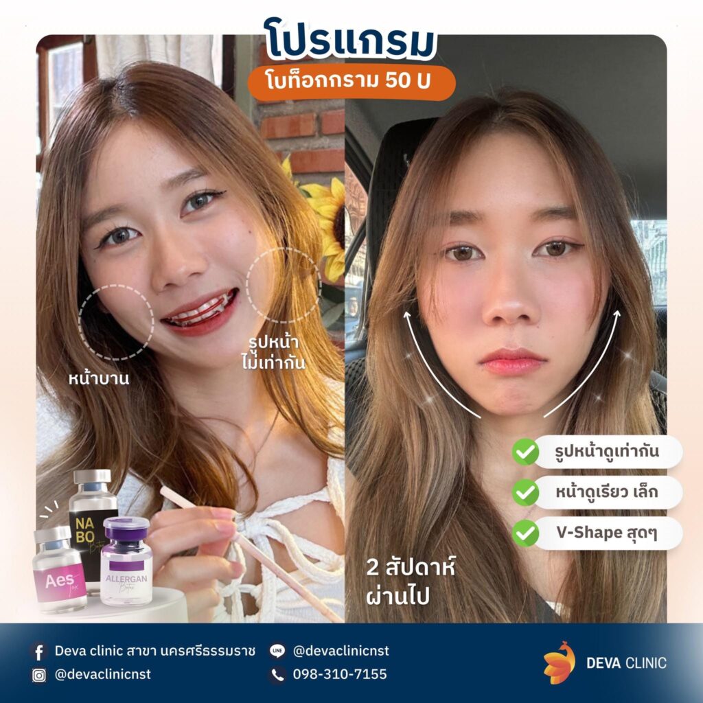 Service-botox botox กราม 6