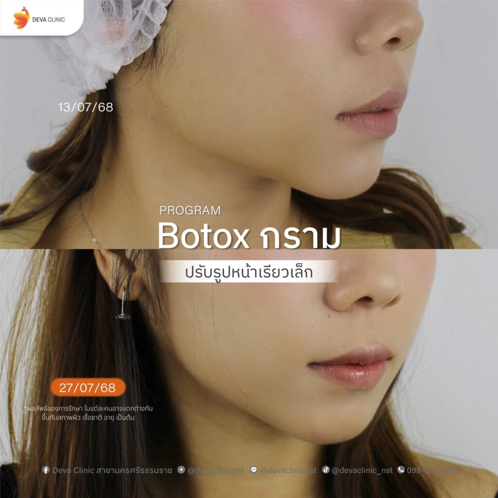 Service-botox botox กราม 7