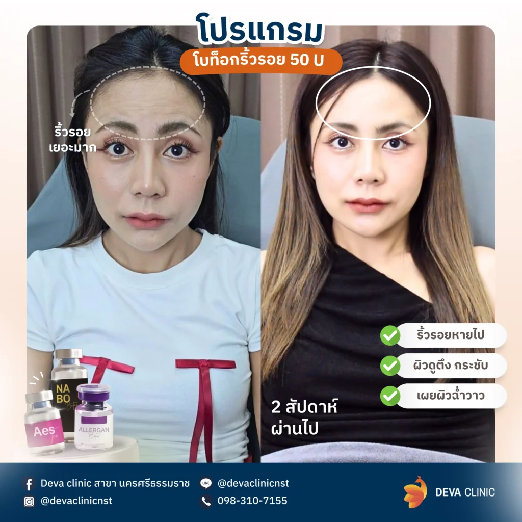 Service-botox botox ริ้วรอย 1