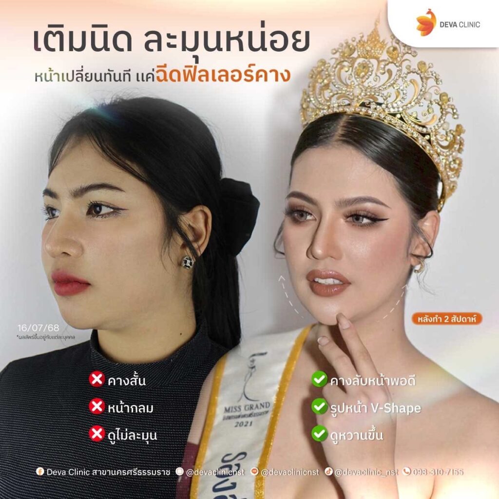 filler คาง 10