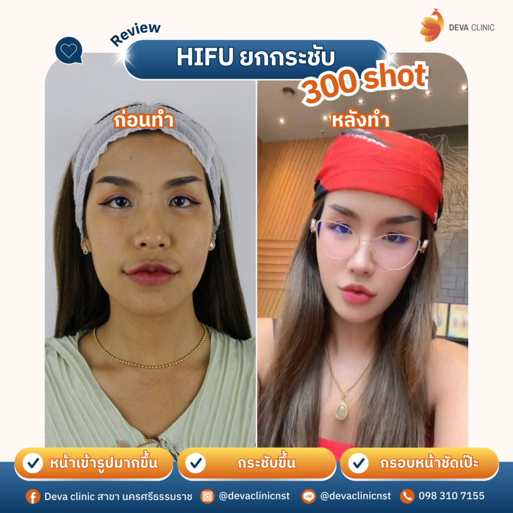 hifu 01