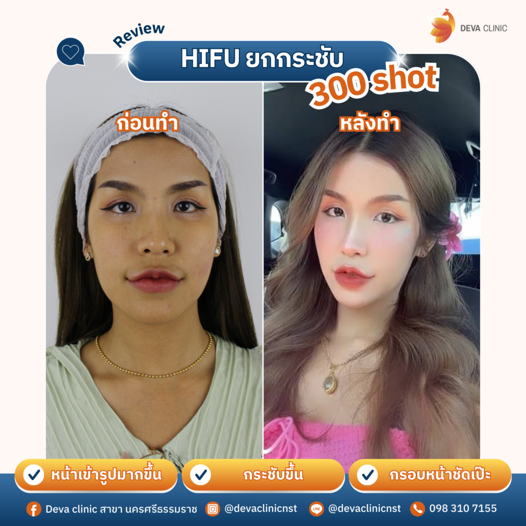 hifu 2
