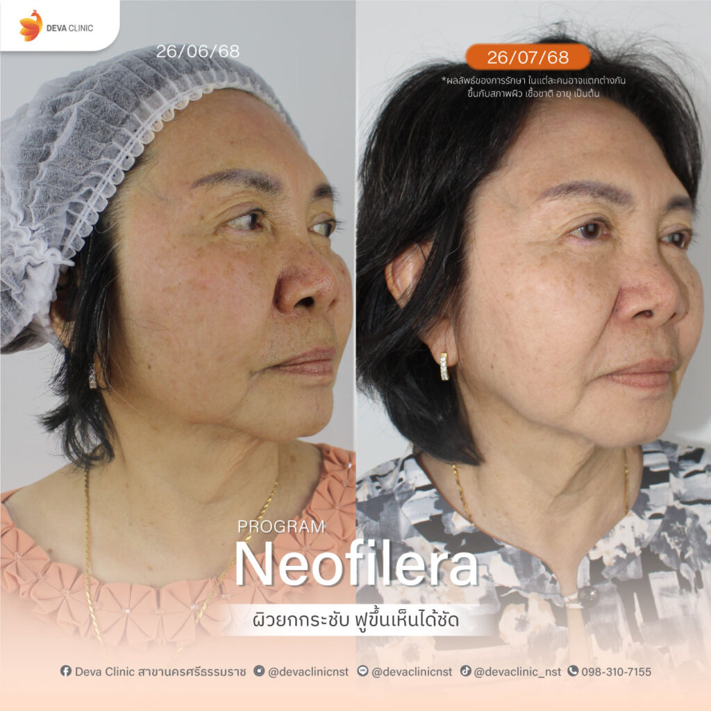 neofilera 1