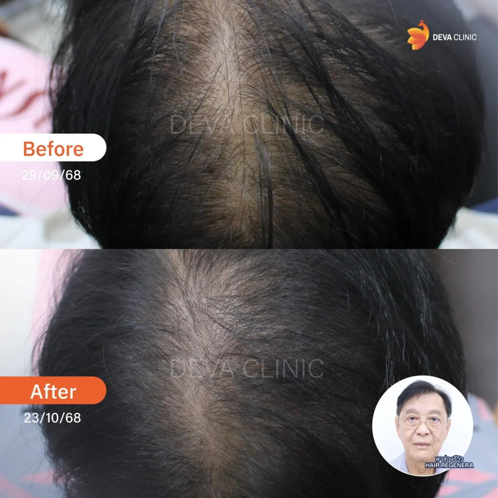 Service-Hair-Regenera hair regenera 7