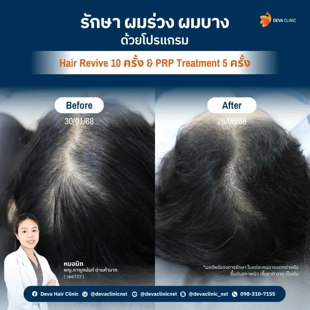 hair revive treatment 4