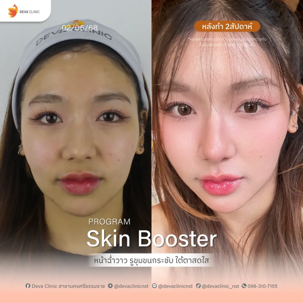 Service-Skin-Booster skin bootster 3