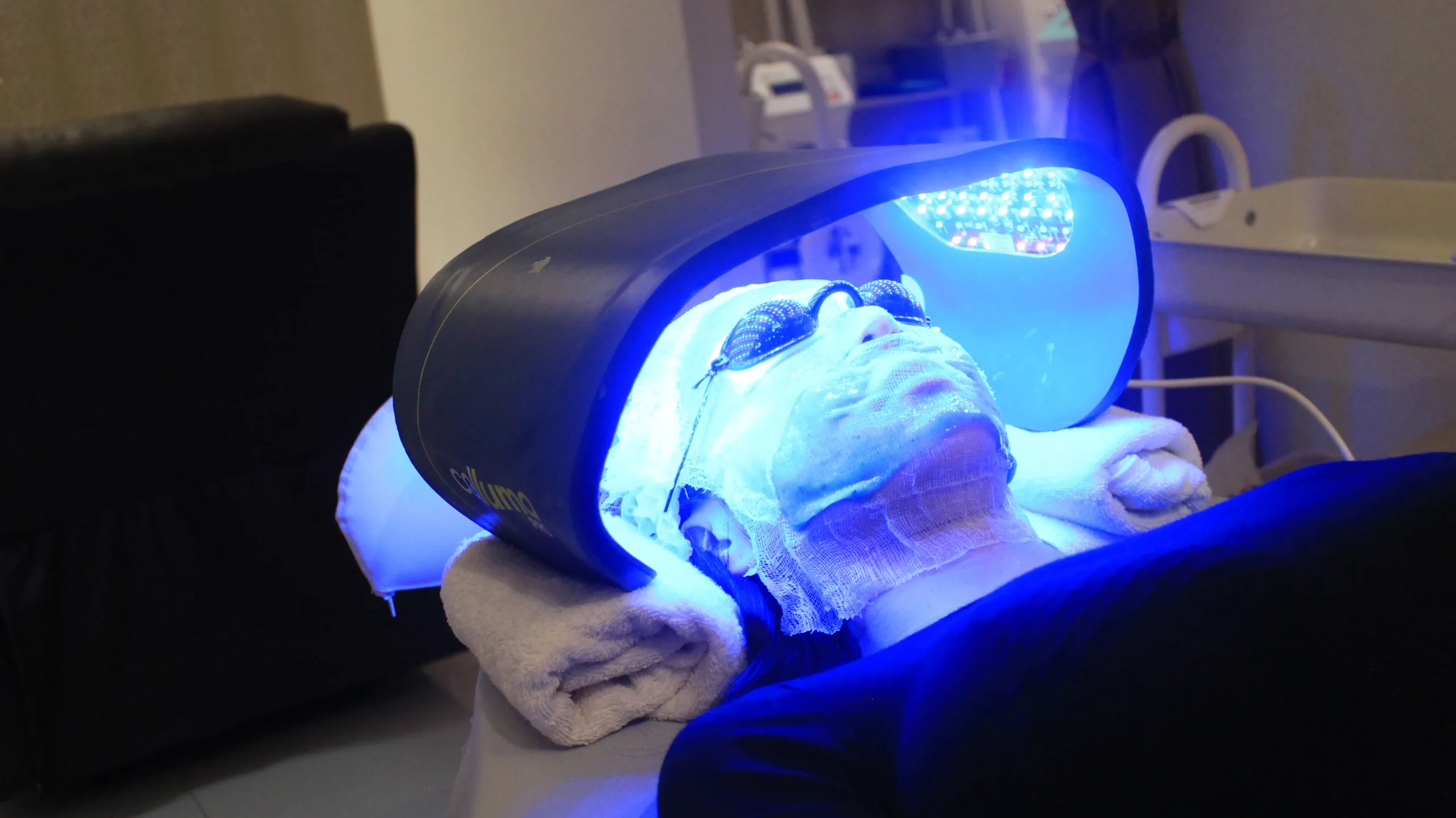 treating acne 2