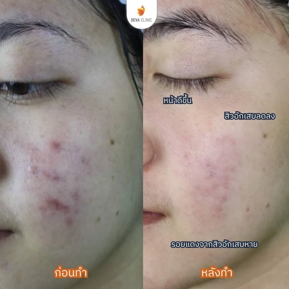 Service-Treating-acne treating acne 3
