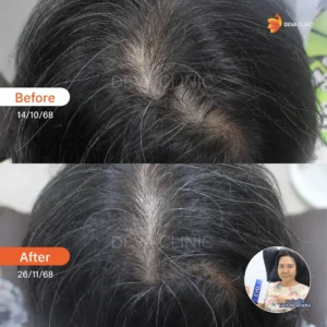 hair regenera5